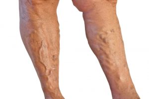 Pernă medicală din varicoză - Perne varifort pentru varice