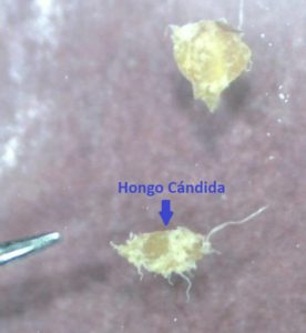 Hongo Candida