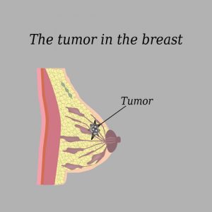 tumor en el pecho