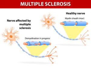 Sclerosis multiple