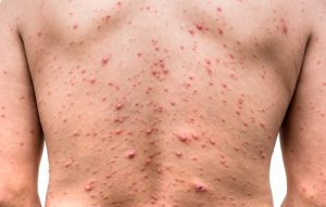 herpes virus que causa la culebrilla codycross