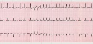 electrocardiograma