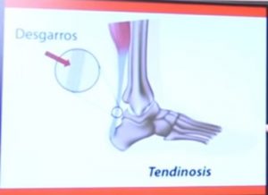 tendonitis