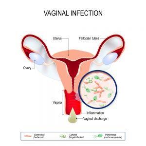 infeccion vaginal