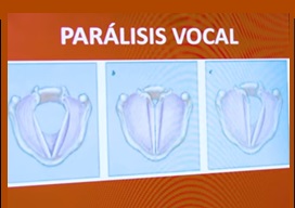 Parálisis vocal